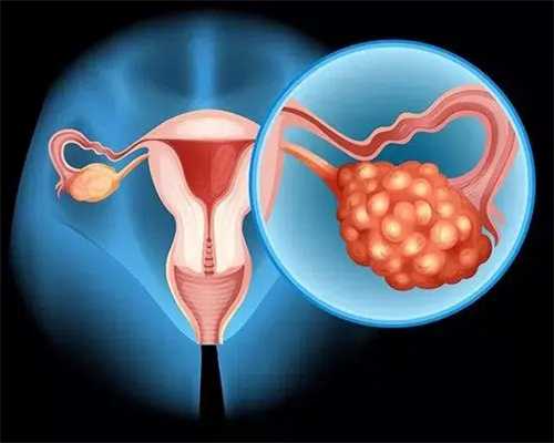 多囊卵巢综合症不治愈就不能自然受孕？还是说