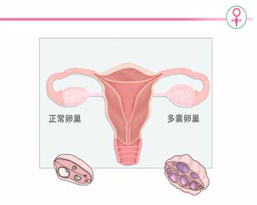 福建面试捐卵,子宫多囊吃什么药 推荐三种有效治