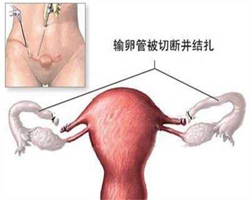 内蒙古捐卵条件,卵巢囊肿会引起腹水吗，如何预