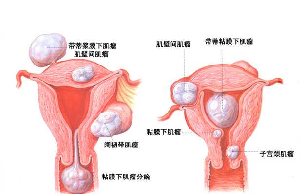 江苏捐卵的过程,良性卵巢囊肿的症状是什么呢