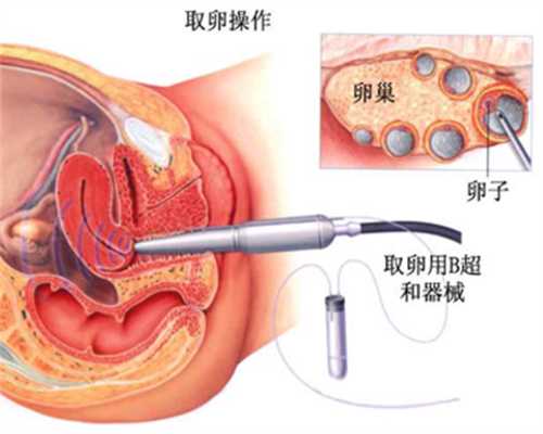 上海捐卵途径,卵巢囊肿必须要手术吗_1