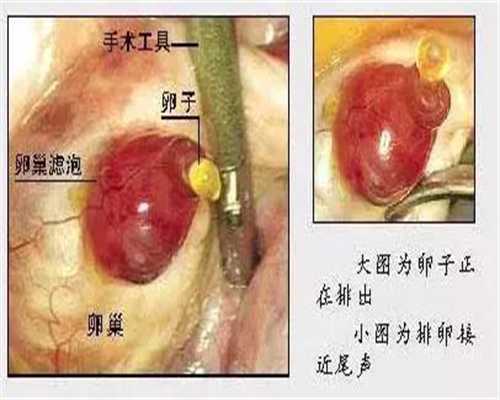 广东国外捐卵,多囊卵巢综合征会引起月经失调吗