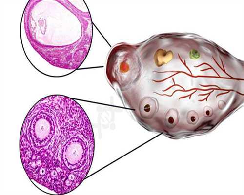 四川捐卵的好处,导致卵巢囊肿的原因有哪些