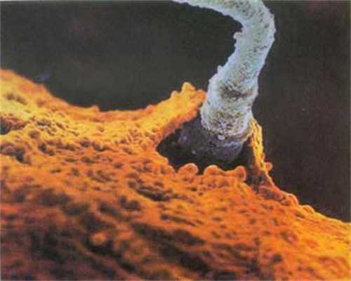 黑龙江捐卵的条件,将卵巢囊肿“吃”小