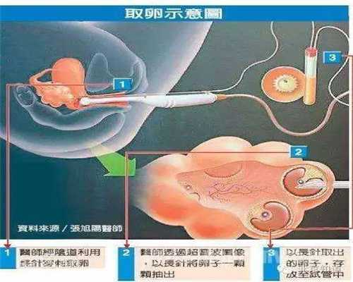 香港哪里找捐卵,卵巢囊肿老流血怎么办