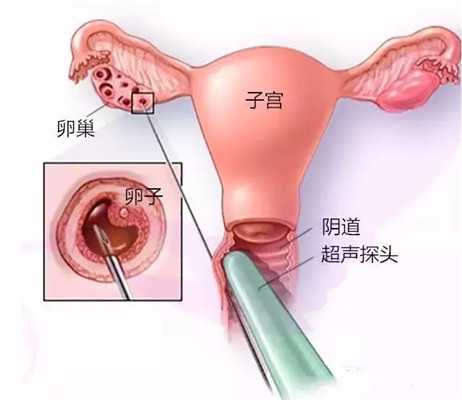 宁波捐卵公司_深圳试管婴儿如何获取优质的卵子与精子呢？_1
